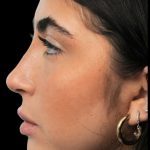 Thumbnail photo of the patient’s after the Rhinoplasty Patient 1