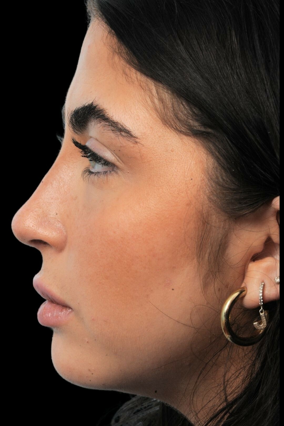 Photo of the patient’s face after the Rhinoplasty surgery. Patient 1 - Set 2