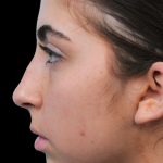 Thumbnail photo of the patient’s before the Rhinoplasty Patient 1