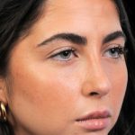 Thumbnail photo of the patient’s after the Rhinoplasty Patient 1