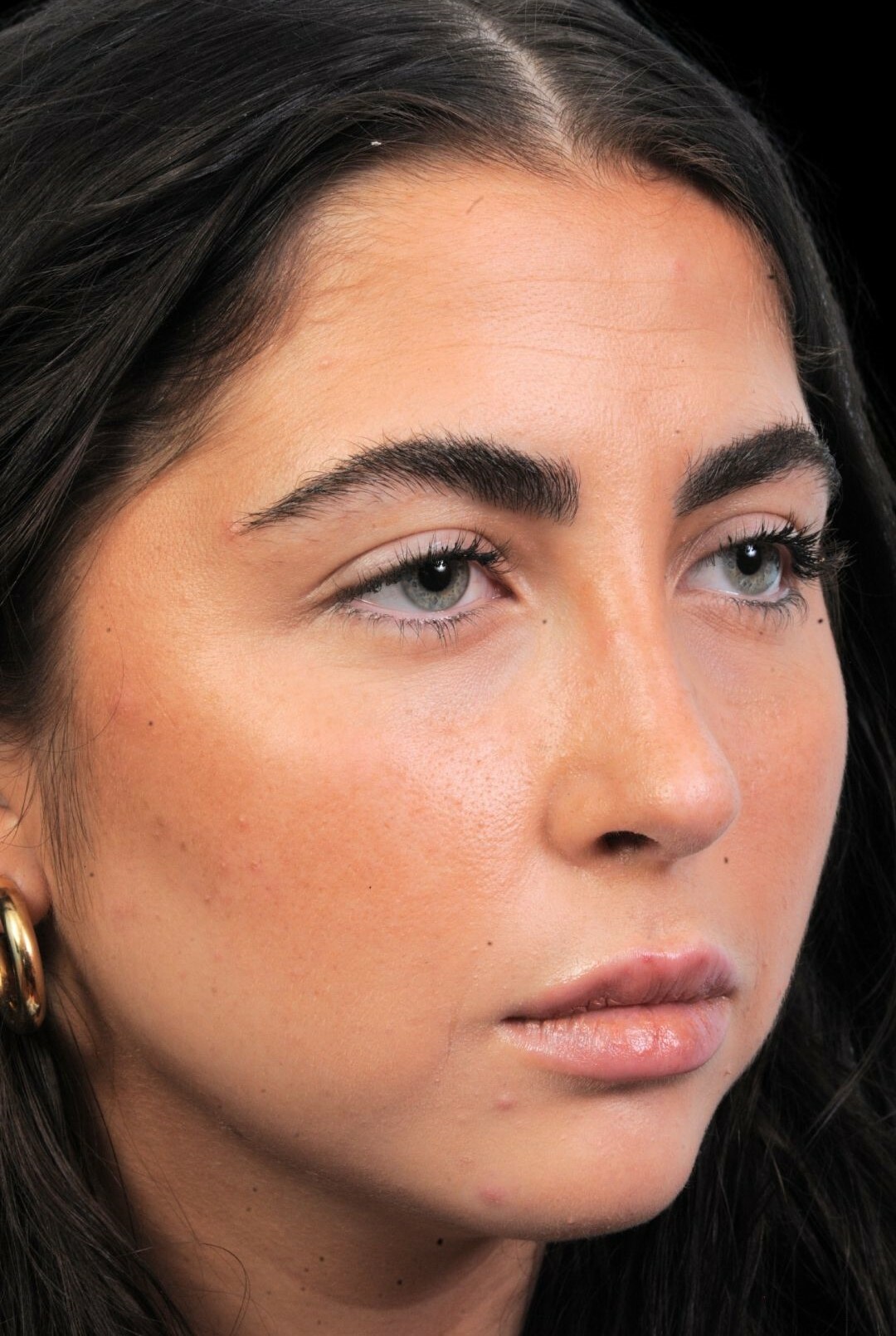 Photo of the patient’s after the Rhinoplasty Patient 1