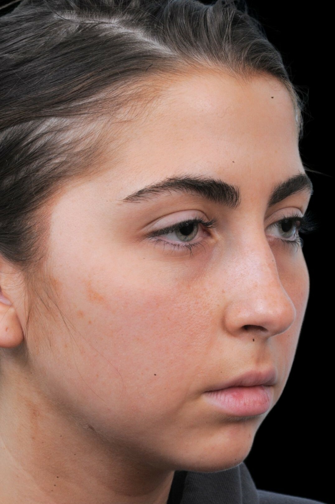 Photo of the patient’s face before the Rhinoplasty surgery. Patient 1 - Set 1