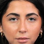 Thumbnail photo of the patient’s after the Rhinoplasty Patient 1