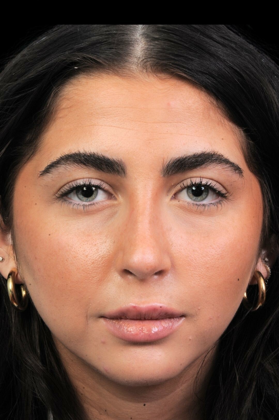 Photo of the patient’s after the Rhinoplasty Patient 1