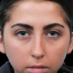 Thumbnail photo of the patient’s before the Rhinoplasty Patient 1