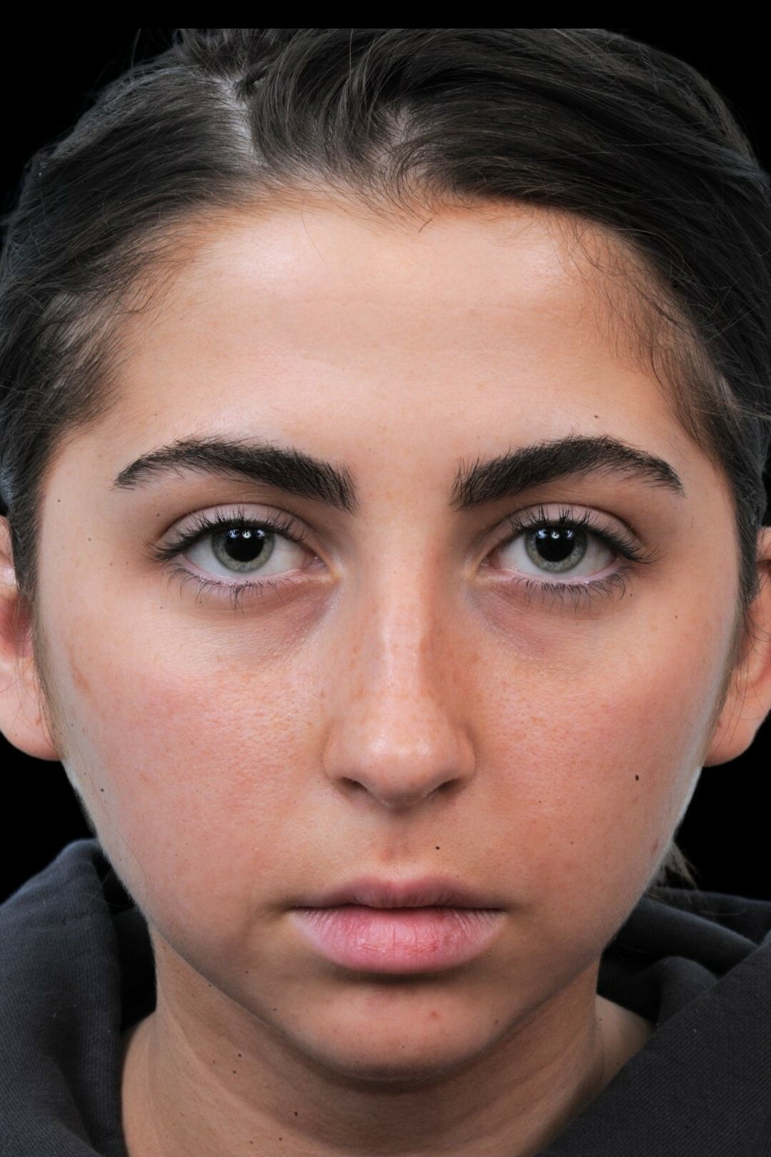 Photo of the patient’s before the Rhinoplasty Patient 1