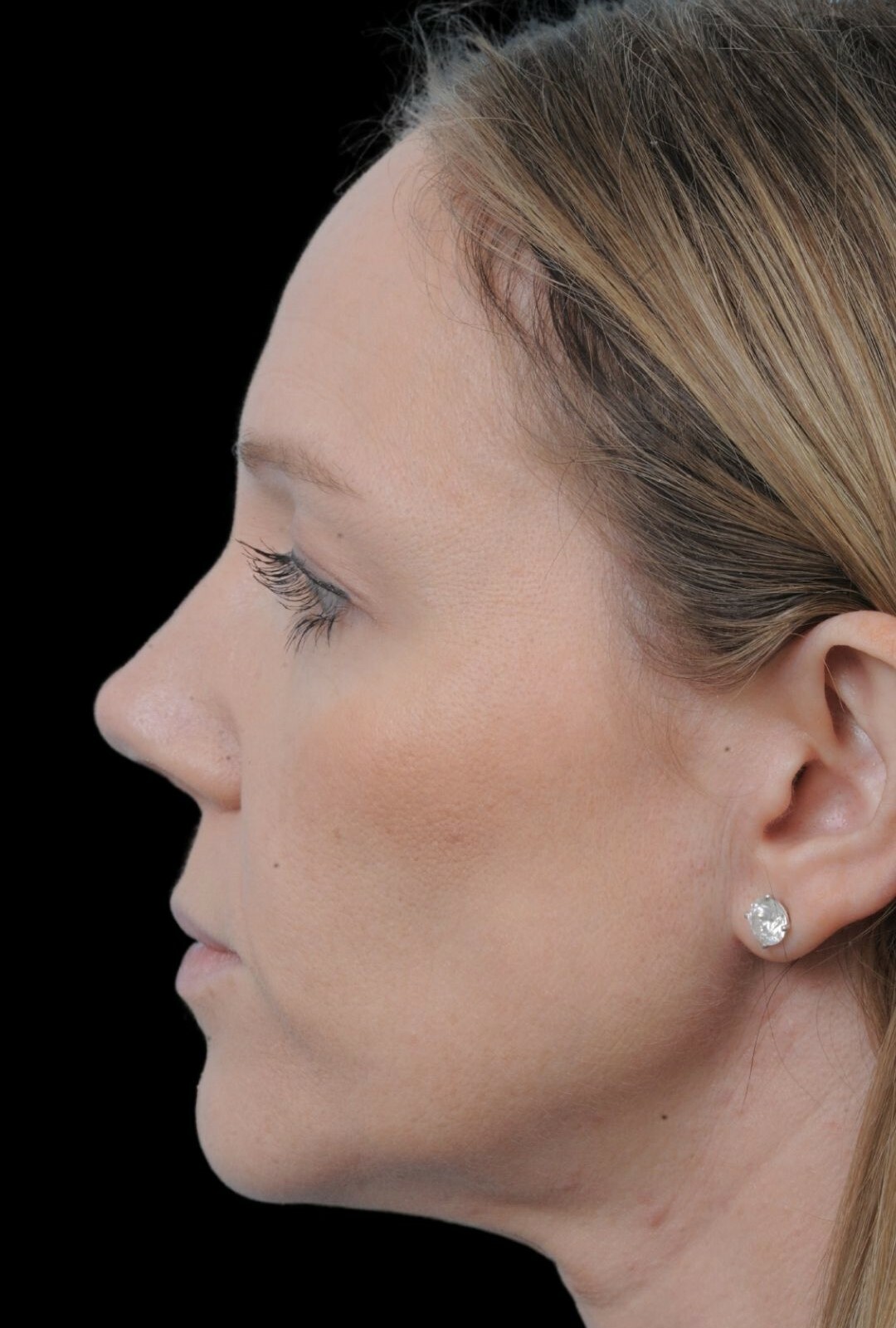 Photo of the patient’s face after the Rhinoplasty surgery. Patient 9 - Set 2