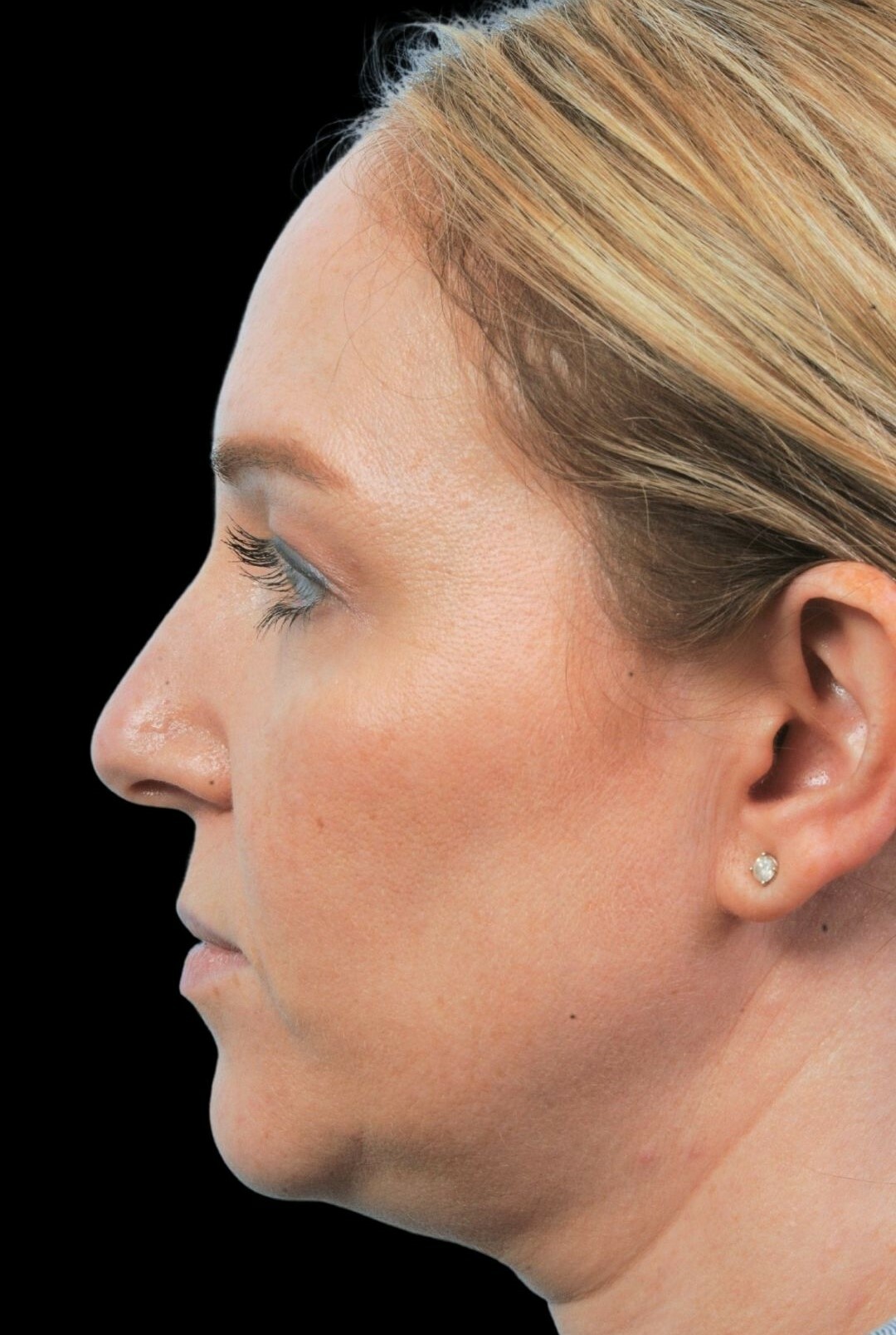 Photo of the patient’s face before the Rhinoplasty surgery. Patient 9 - Set 2