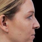 Photo of the patient’s face before the Rhinoplasty surgery. Patient 9 - Set 1