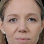 Thumbnail photo of the patient’s after the Rhinoplasty Patient 9