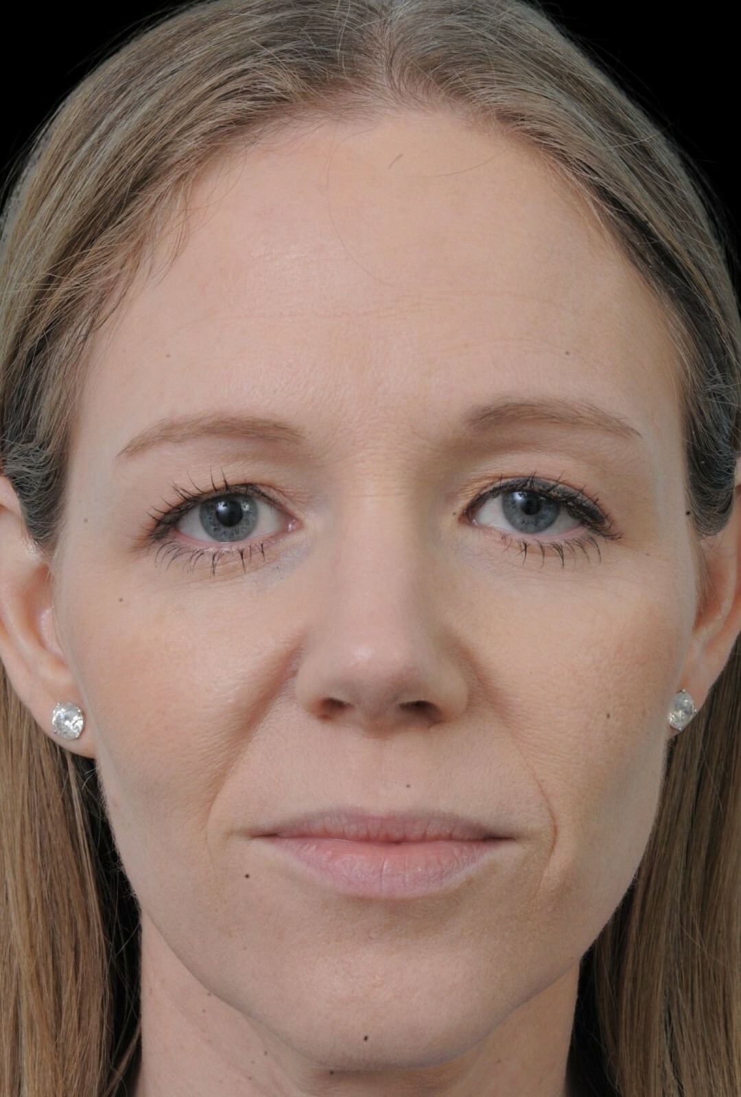 Photo of the patient’s after the Rhinoplasty Patient 9