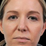 Thumbnail photo of the patient’s before the Rhinoplasty Patient 9