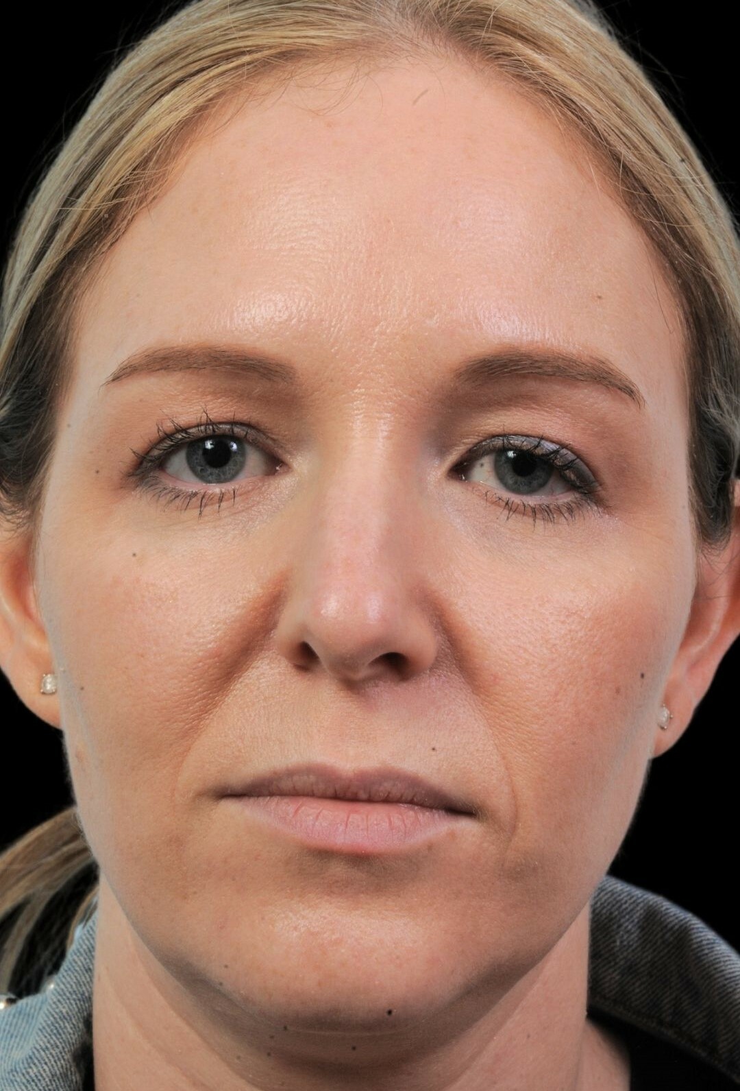 Photo of the patient’s before the Rhinoplasty Patient 9