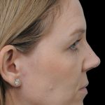 Thumbnail photo of the patient’s after the Rhinoplasty Patient 9