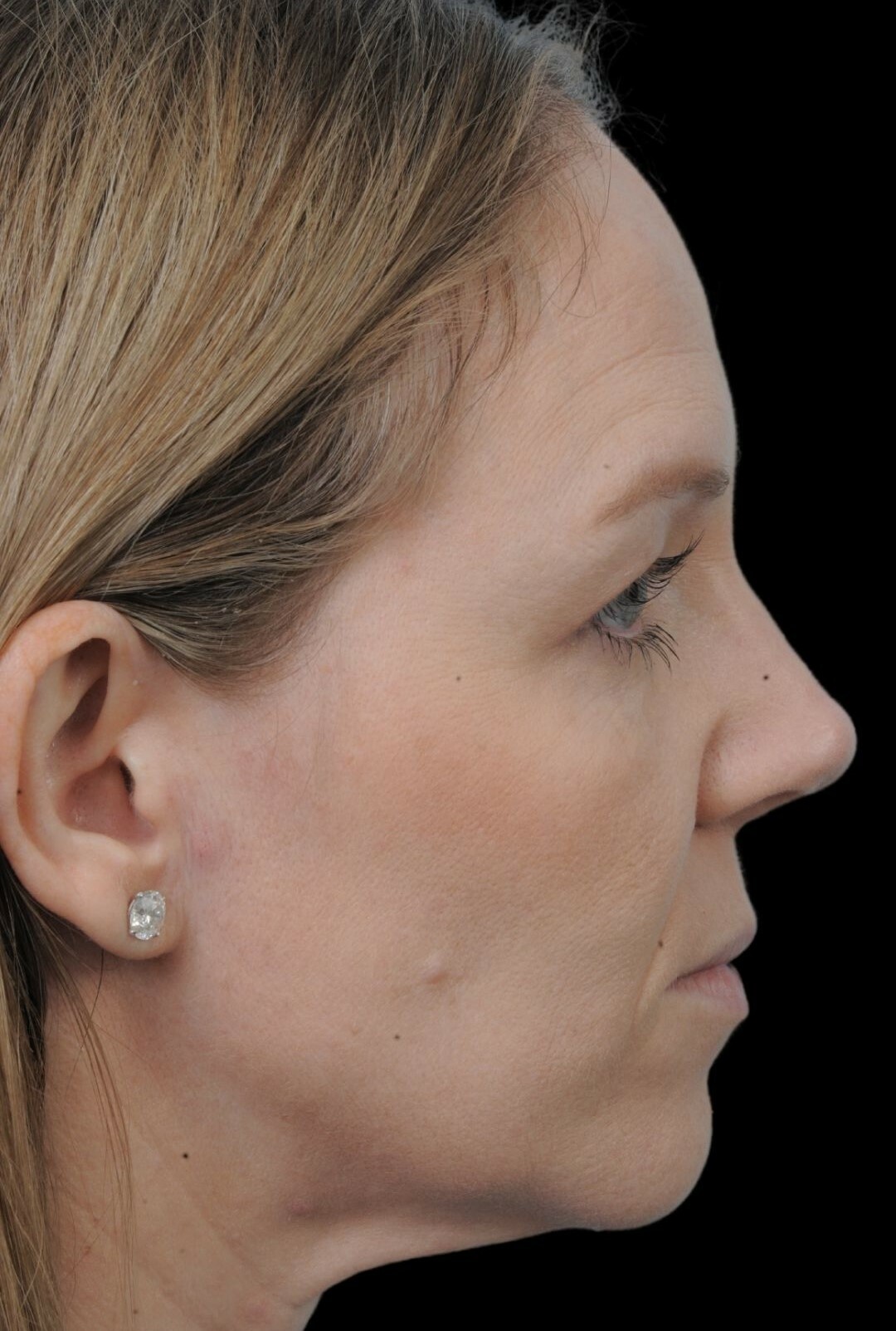Photo of the patient’s face after the Rhinoplasty surgery. Patient 9 - Set 1