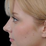 Thumbnail photo of the patient’s after the Rhinoplasty Patient 10