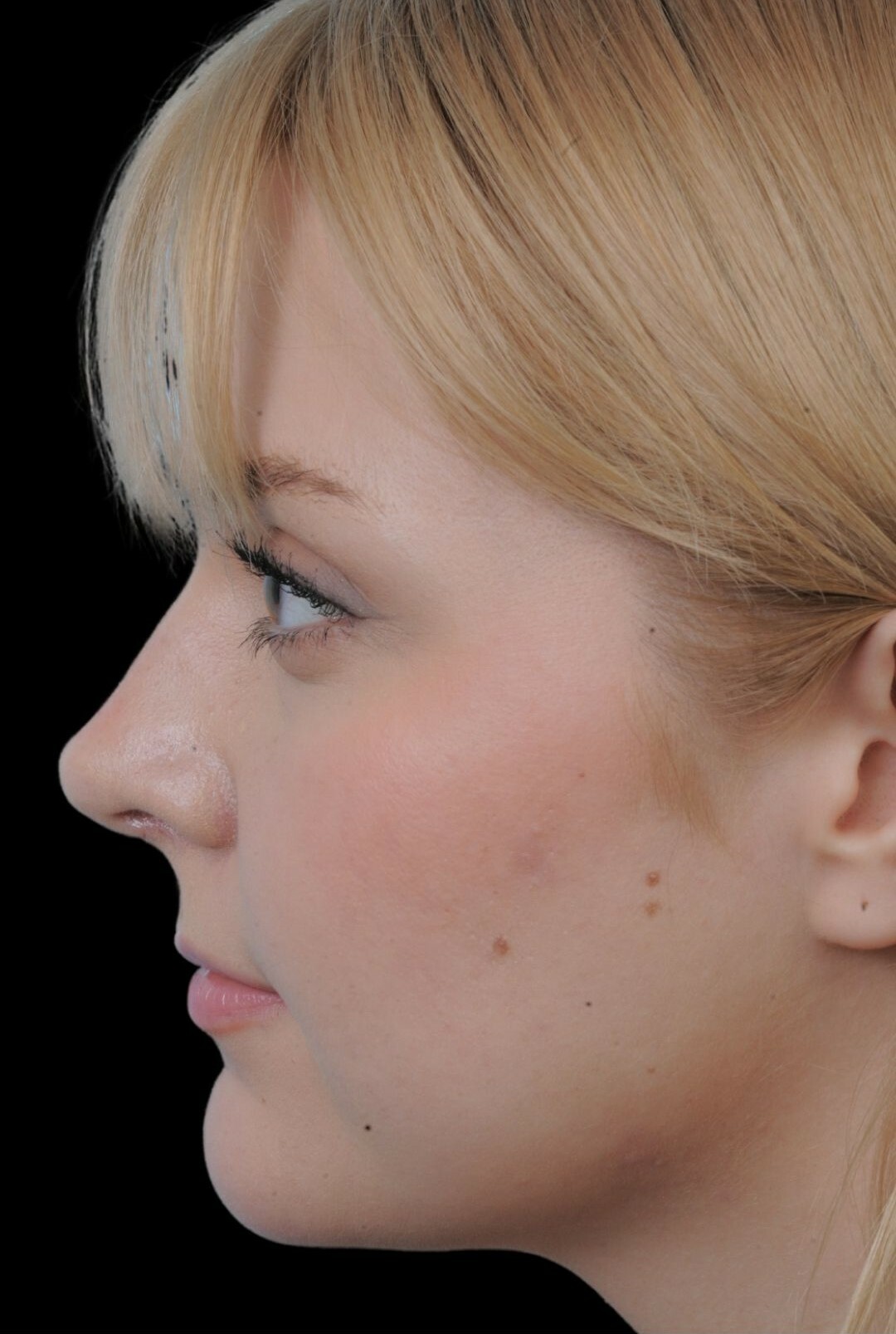 Photo of the patient’s face after the Rhinoplasty surgery. Patient 10 - Set 2