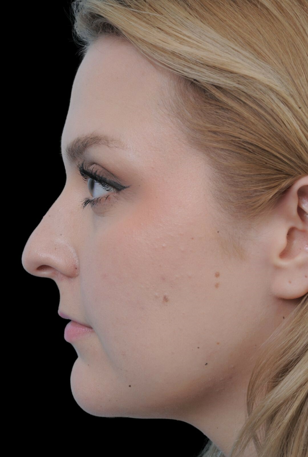 Photo of the patient’s face before the Rhinoplasty surgery. Patient 10 - Set 2