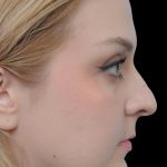 Thumbnail photo of the patient’s after the Rhinoplasty Patient 10