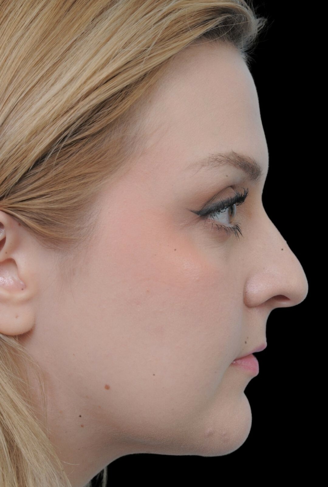 Photo of the patient’s after the Rhinoplasty Patient 10