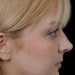 Thumbnail photo of the patient’s before the Rhinoplasty Patient 10