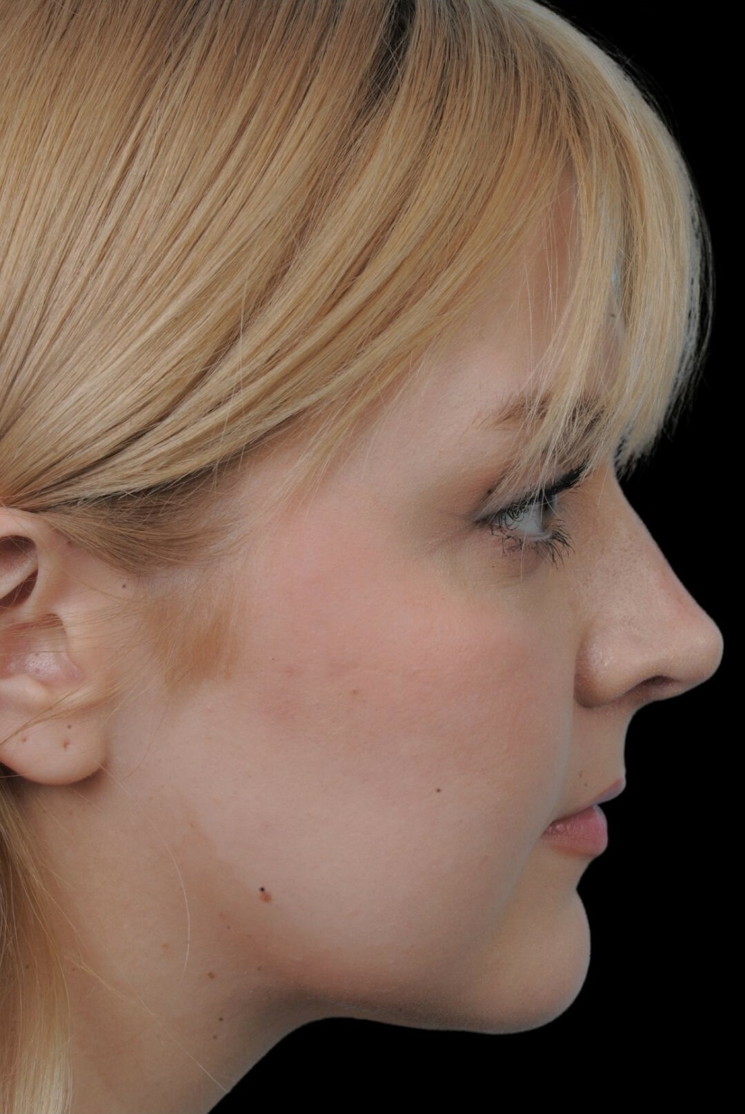 Photo of the patient’s face after the Rhinoplasty surgery. Patient 10 - Set 1