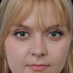 Thumbnail photo of the patient’s after the Rhinoplasty Patient 10