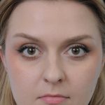 Thumbnail photo of the patient’s before the Rhinoplasty Patient 10