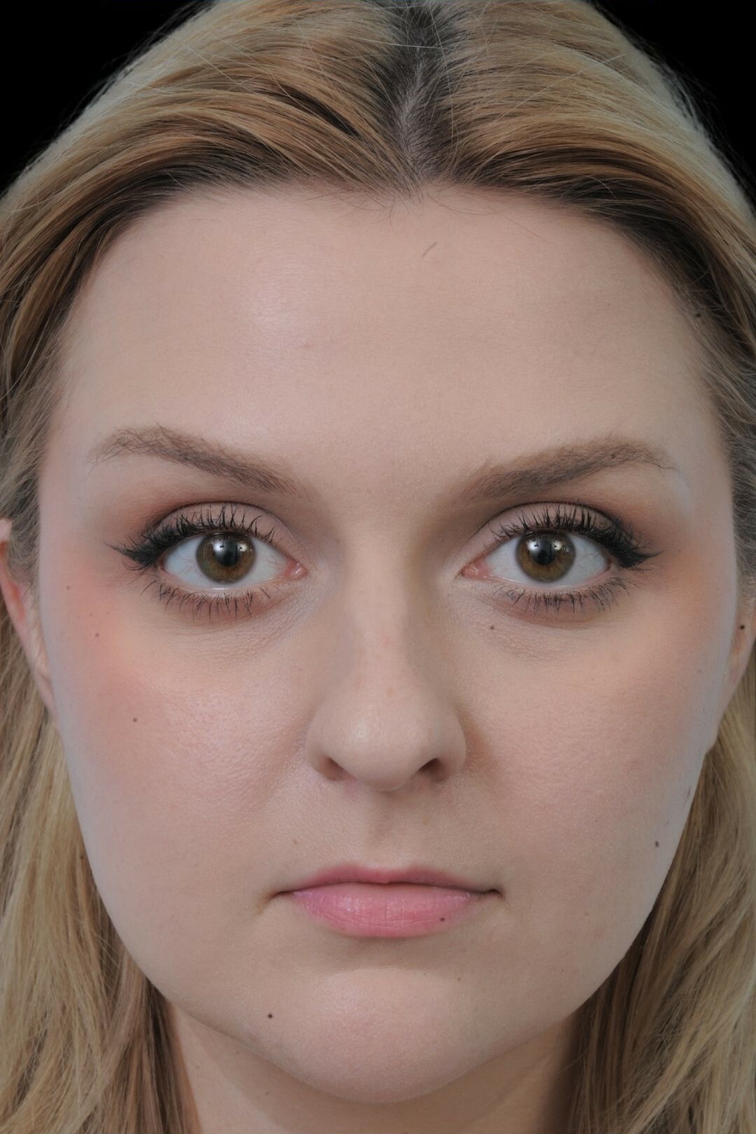 Photo of the patient’s before the Rhinoplasty Patient 10