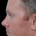 Thumbnail photo of the patient’s after the Rhinoplasty Patient 16