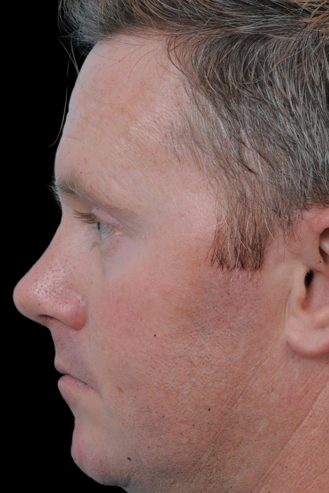 Photo of the patient’s after the Rhinoplasty Patient 16