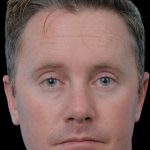 Thumbnail photo of the patient’s after the Rhinoplasty Patient 16