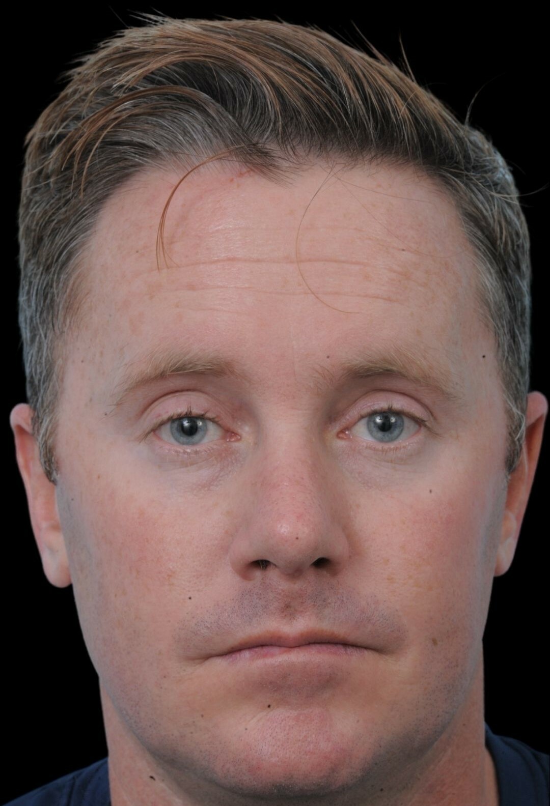 Photo of the patient’s after the Rhinoplasty Patient 16