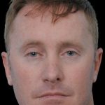 Thumbnail photo of the patient’s before the Rhinoplasty Patient 16