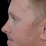 Thumbnail photo of the patient’s before the Rhinoplasty Patient 16