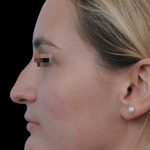 Thumbnail photo of the patient’s before the Rhinoplasty Patient 18