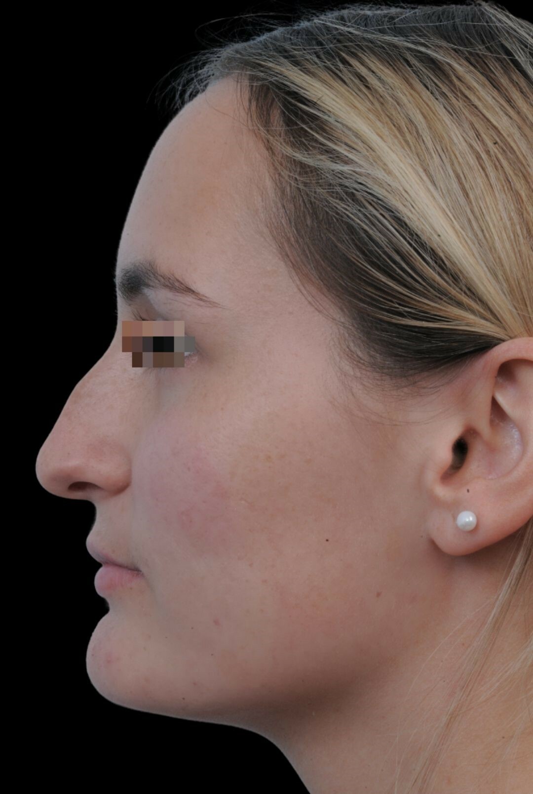 Photo of the patient’s face before the Rhinoplasty surgery. Patient 18 - Set 1