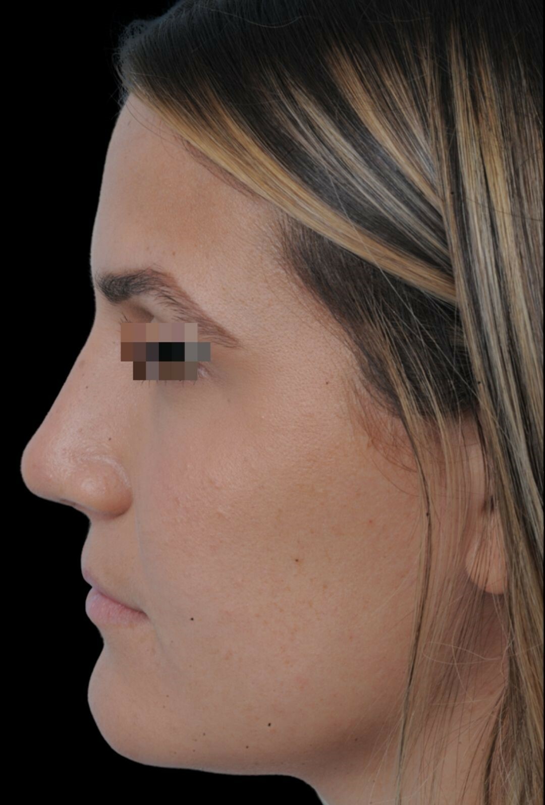 Photo of the patient’s after the Rhinoplasty Patient 19