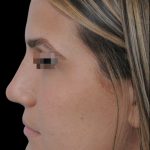 Photo of the patient’s face after the Rhinoplasty surgery. Patient 19 - Set 1