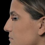 Thumbnail photo of the patient’s before the Rhinoplasty Patient 19