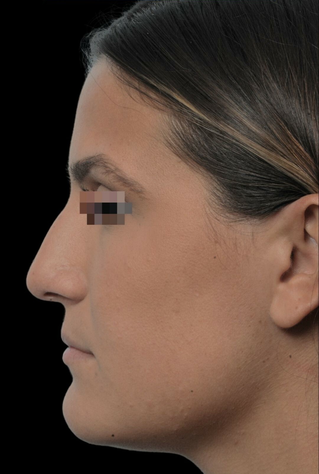Photo of the patient’s face before the Rhinoplasty surgery. Patient 19 - Set 1