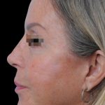 Thumbnail photo of the patient’s after the Rhinoplasty Patient 17