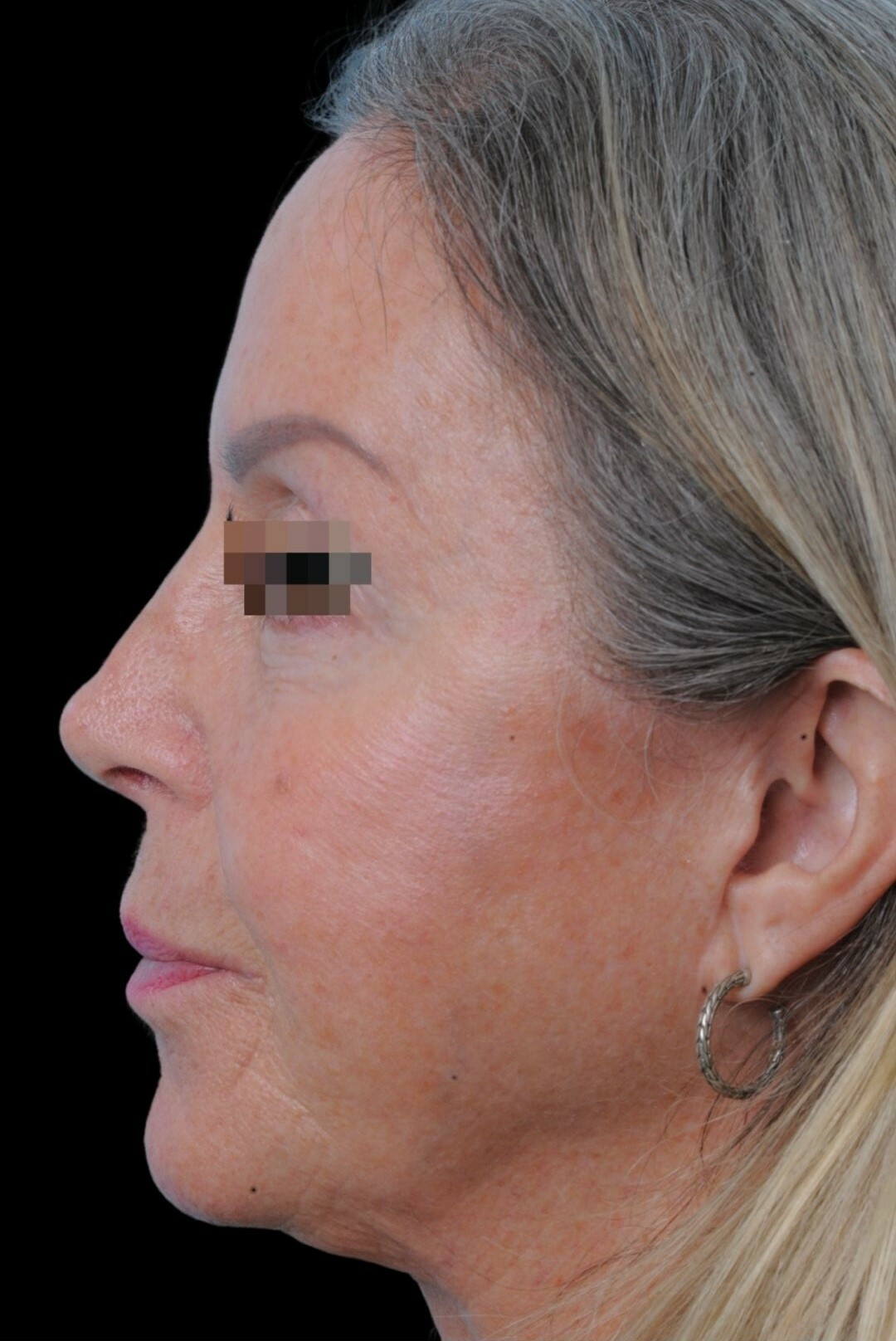 Photo of the patient’s face after the Rhinoplasty surgery. Patient 17 - Set 1