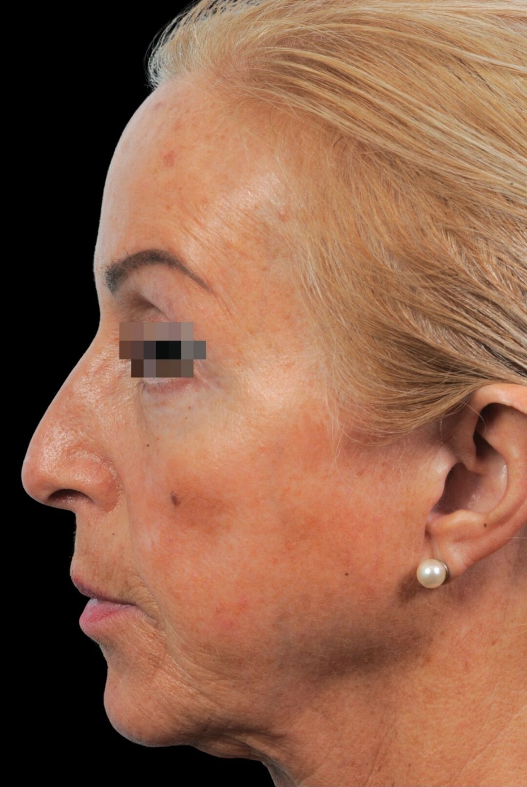 Photo of the patient’s face before the Rhinoplasty surgery. Patient 17 - Set 1