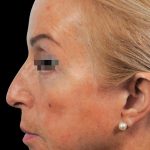 Thumbnail photo of the patient’s before the Rhinoplasty Patient 17