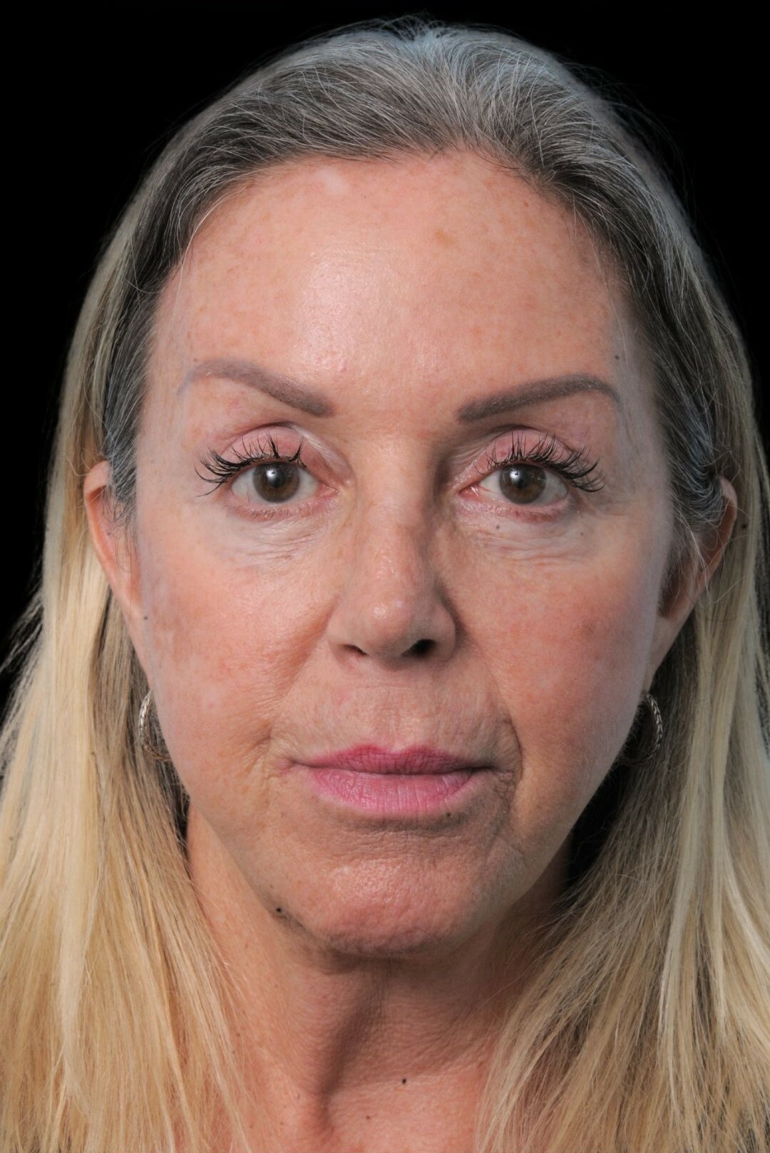 Photo of the patient’s face after the Rhinoplasty surgery. Patient 17 - Set 2