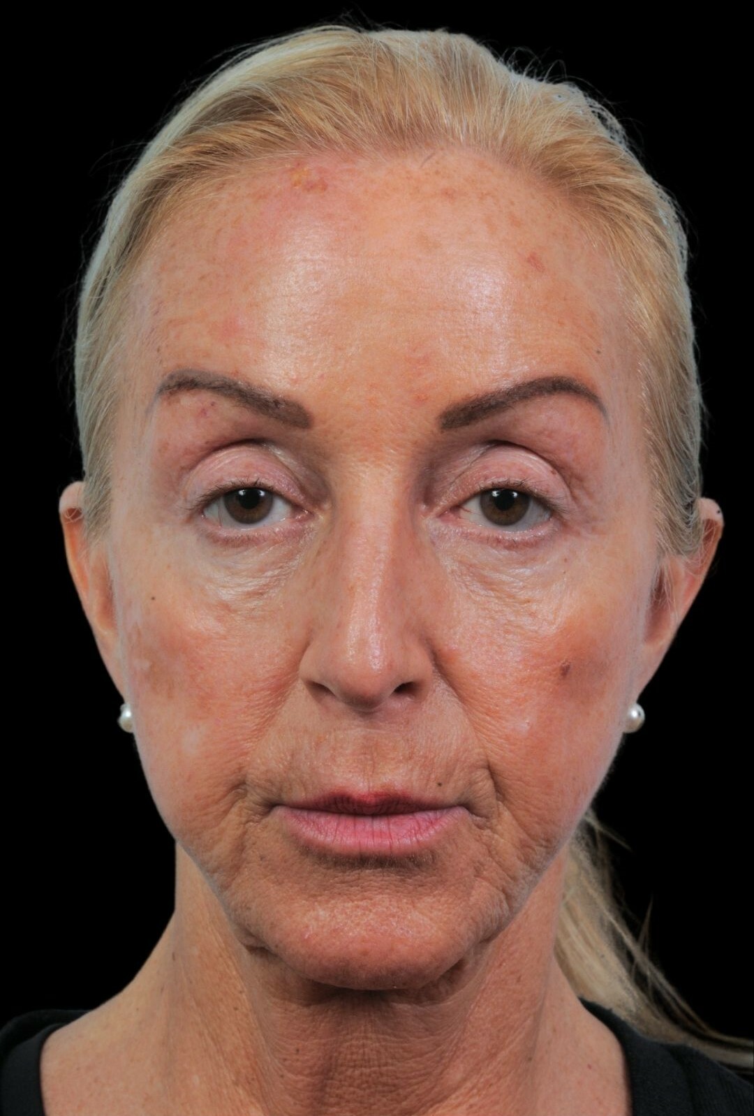 Photo of the patient’s face before the Rhinoplasty surgery. Patient 17 - Set 2