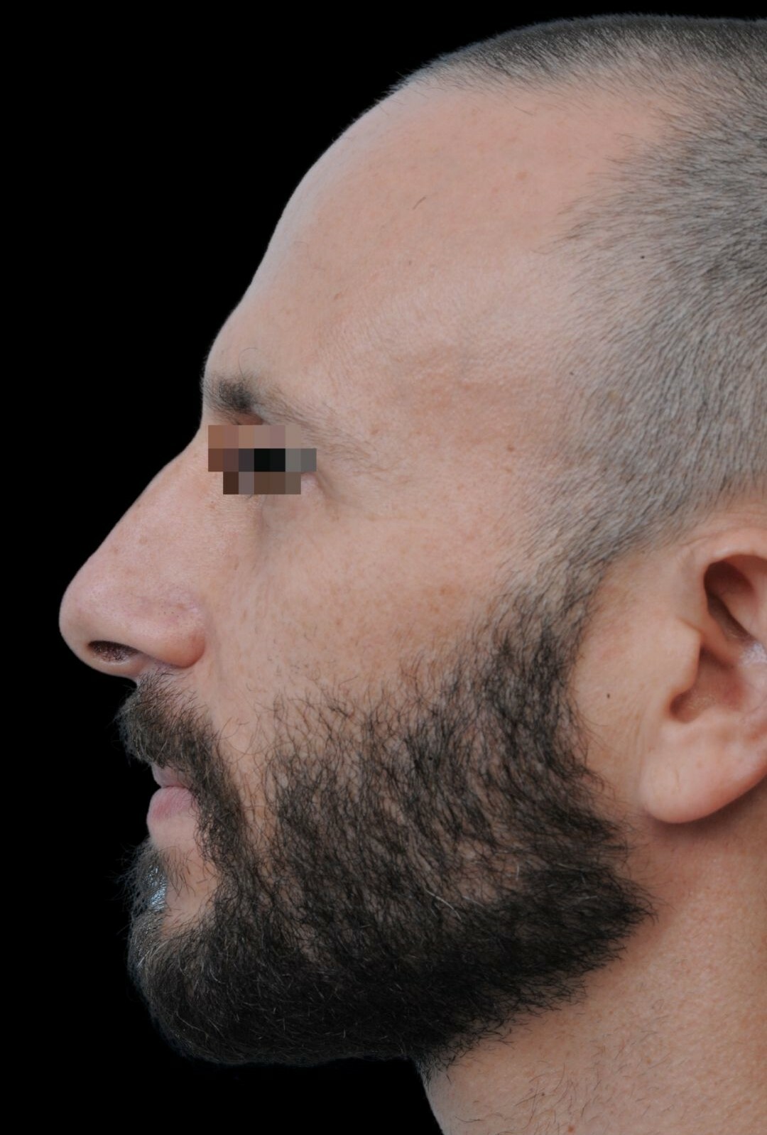 Photo of the patient’s face before the Rhinoplasty surgery. Patient 20 - Set 1