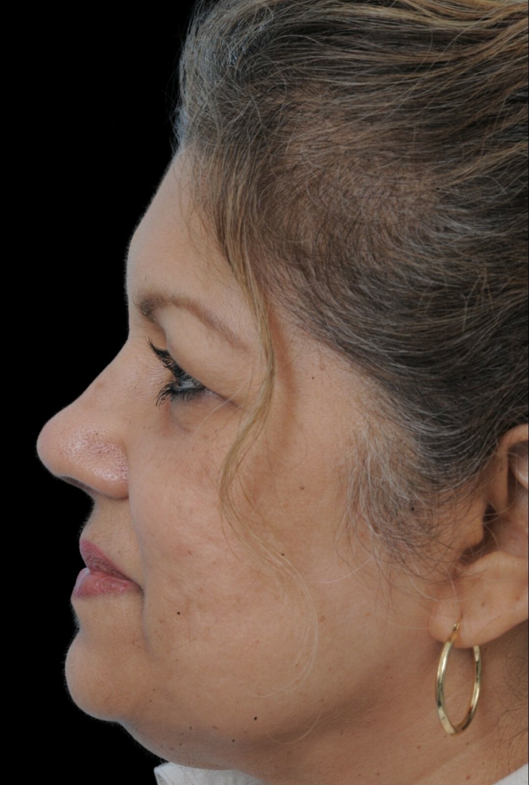 Photo of the patient’s face after the Rhinoplasty surgery. Patient 11 - Set 2