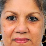 Thumbnail photo of the patient’s after the Rhinoplasty Patient 11